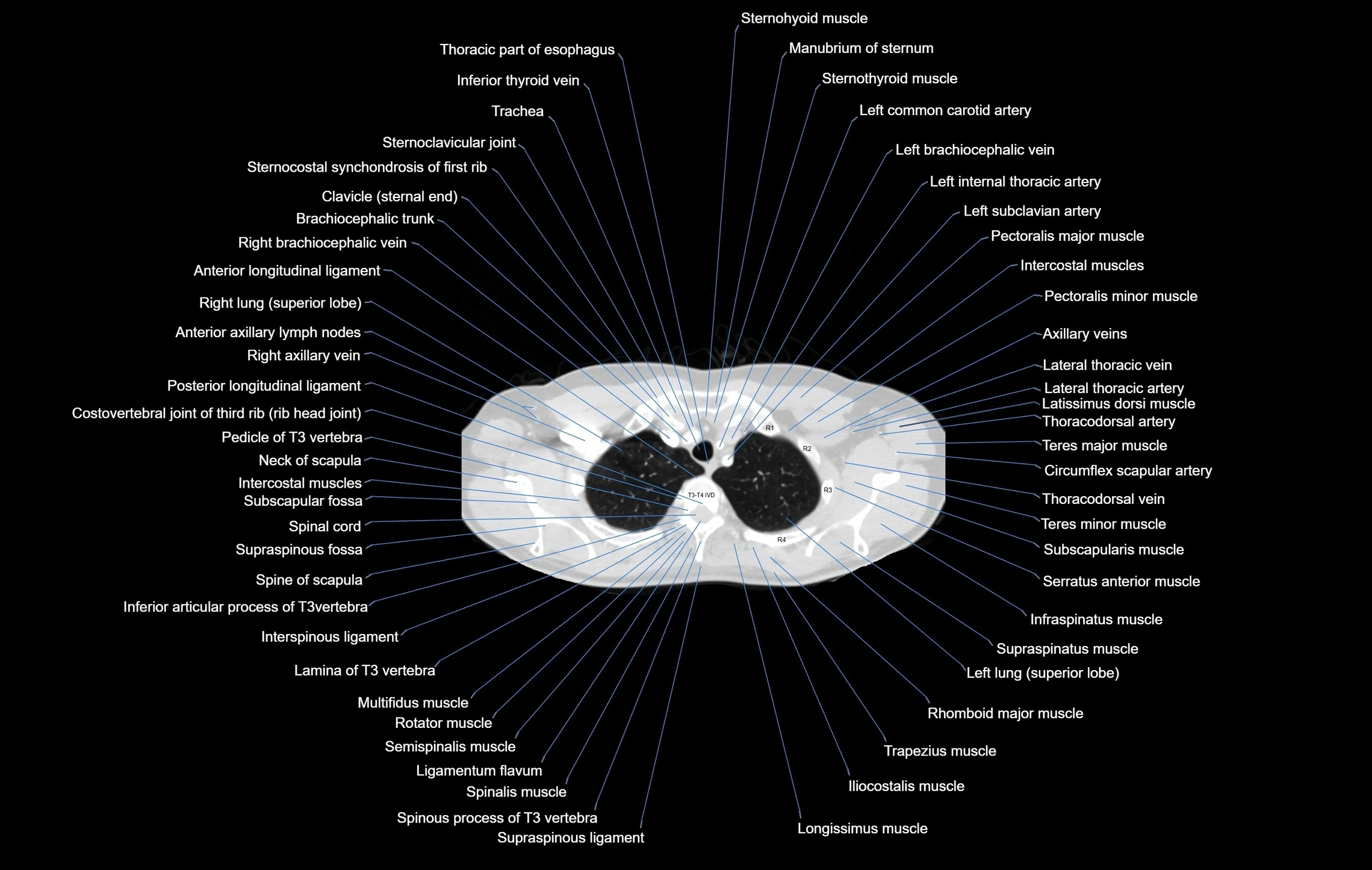 CT chest (thorax) labelled axial cross sectional anatomy radiology image-00019.webp